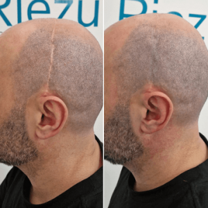 cobertura-cicatrices-cabello-riezu-antes-despues-2