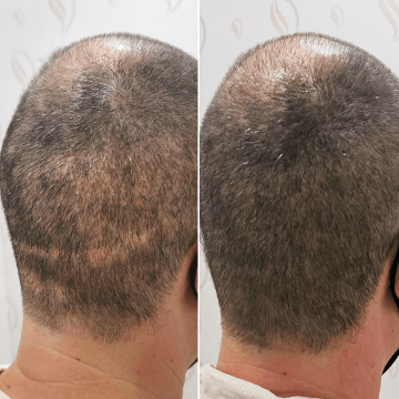 cobertura-cicatrices-cabello-riezu-antes-despues-3