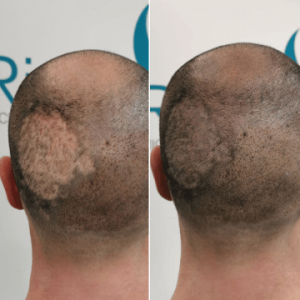 cobertura-cicatrices-cabello-riezu-antes-despues-4