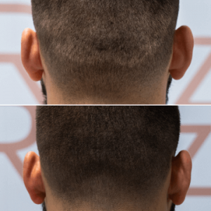 cobertura-cicatrices-cabello-riezu-antes-despues-5